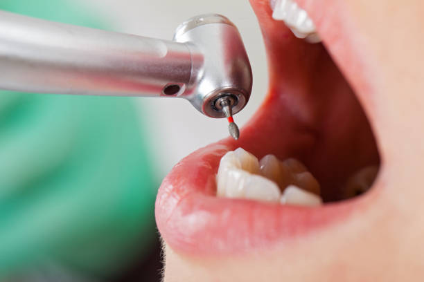 Best Dentist for Tooth Abscess  in La Grulla, TX